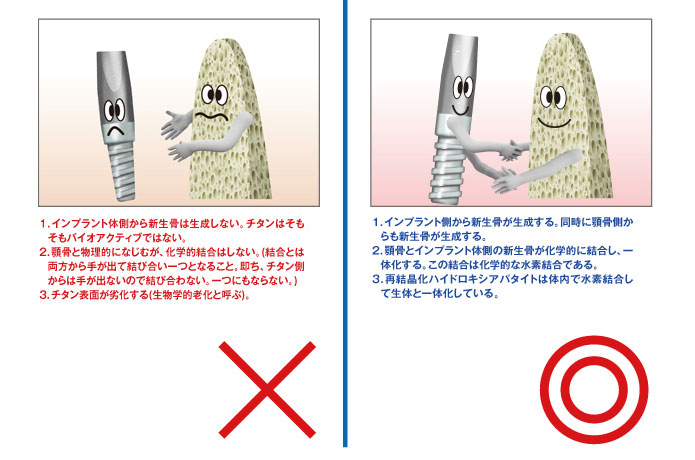 インプラント比較図