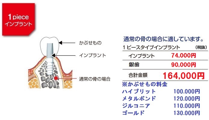 1ピースインプラント料金