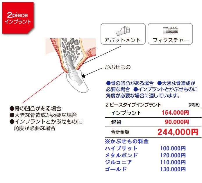 2ピースインプラント料金