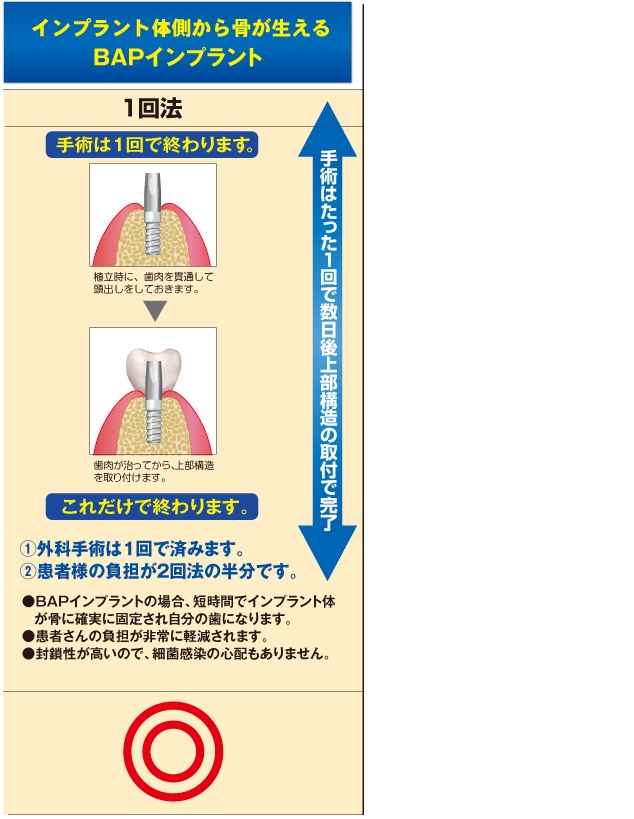 BAPインプラント