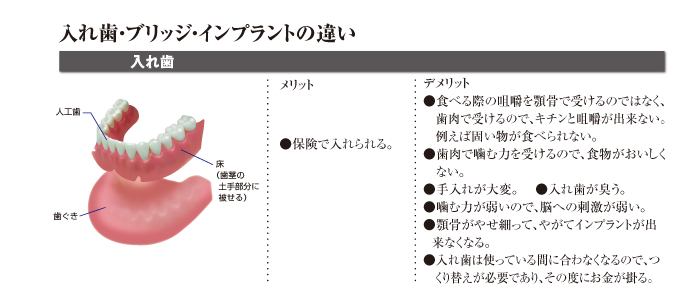 入れ歯との違い