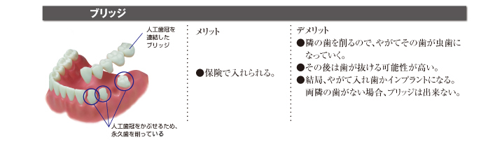 ブリッジとの違い