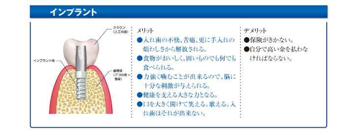 インプラント