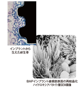 BAPインプラント